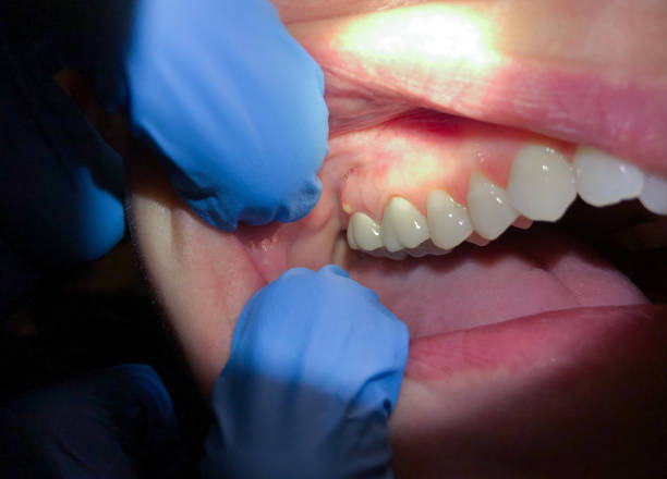 Best Emergency Wisdom Teeth Removal in Macopin, NJ